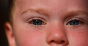 conjunctivitis in children, pink eye