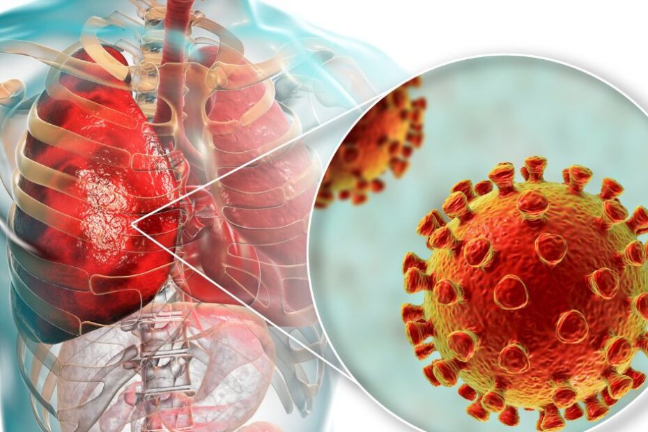 walking pneumonia cases, atopical pneumonia