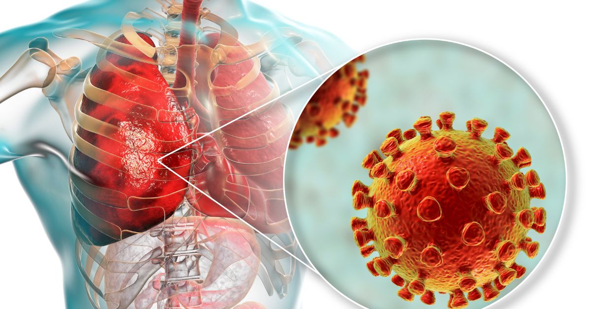 walking pneumonia cases, atopical pneumonia